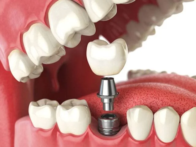 What is a Dental Implants?
