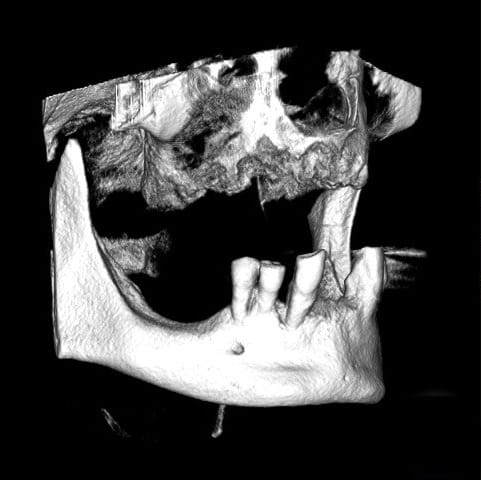 Why Is All on 4 Performed? Who Is the Ideal Candidate for All on 4 Dental Implants?