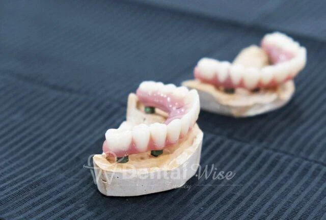 How Long Does All on 4 Treatment Take, and When Does It Conclude?