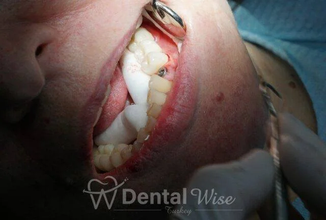 Dental Implant Treatment in One Day in Antalya/Turkey