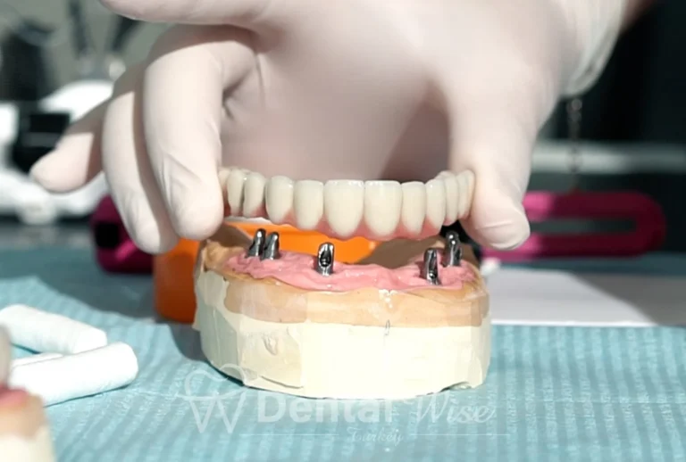 What are the advantages of a teeth implant?