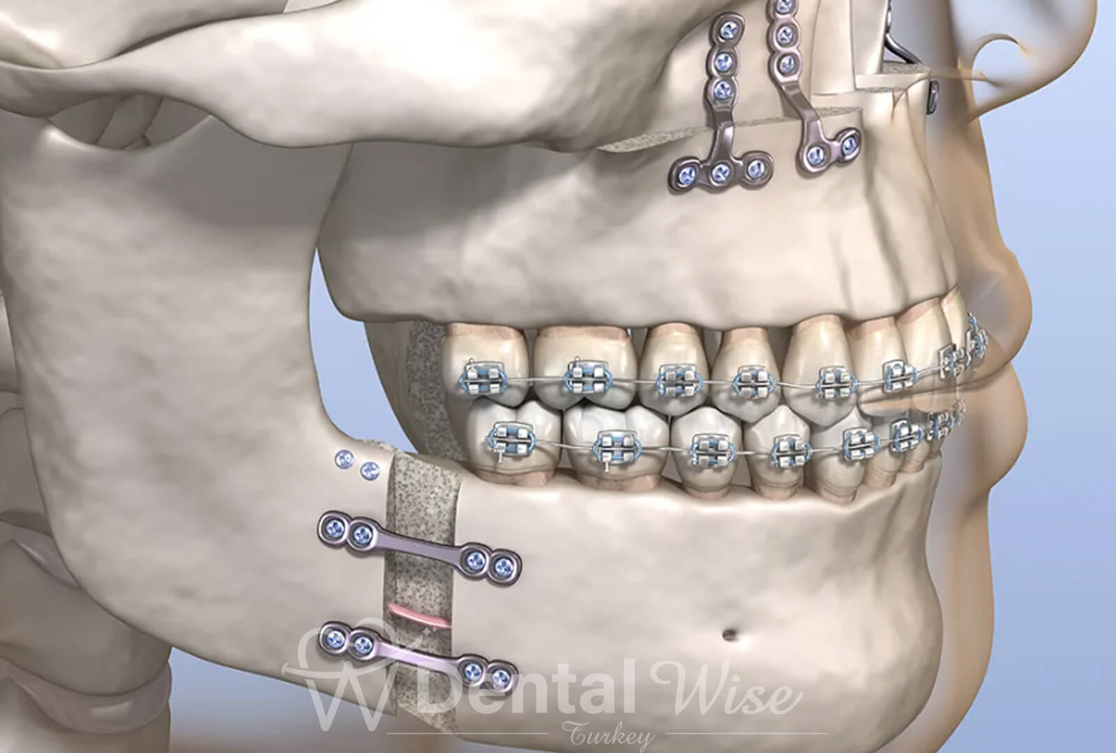 Oral,Dental and Maxillofacial Surgery In Antalya Turkey