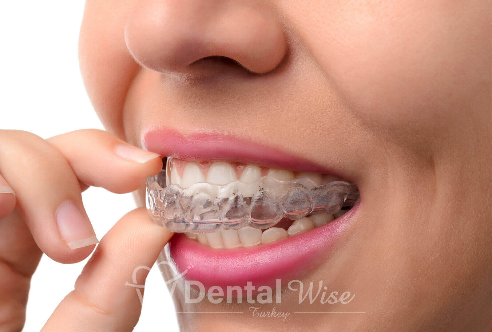 Common Orthodontic Issues