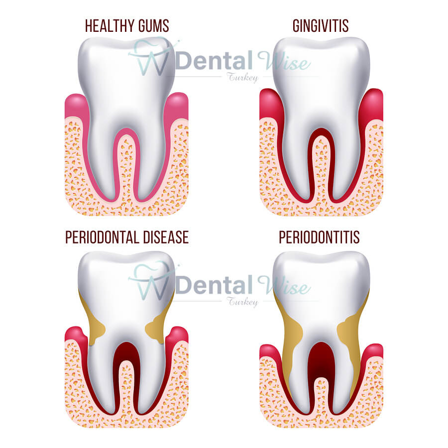 Periodontal Treatments In Antalya Turkey
