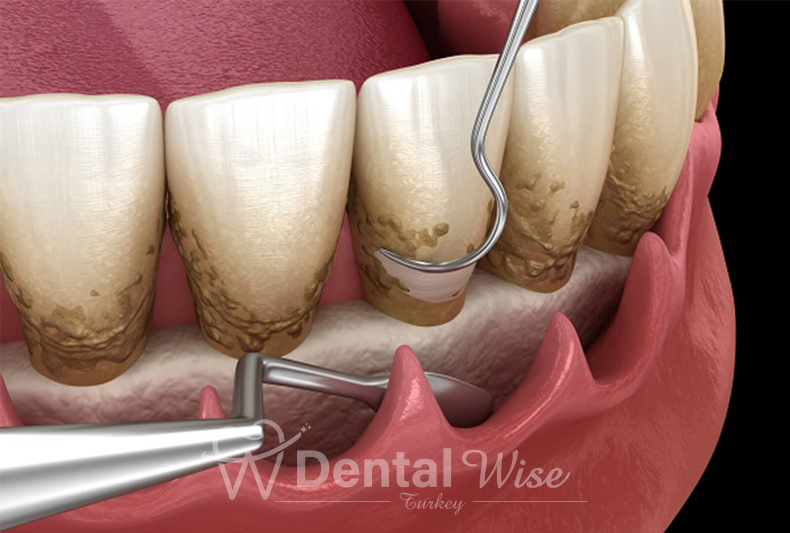 What Is Periodontal Disease?