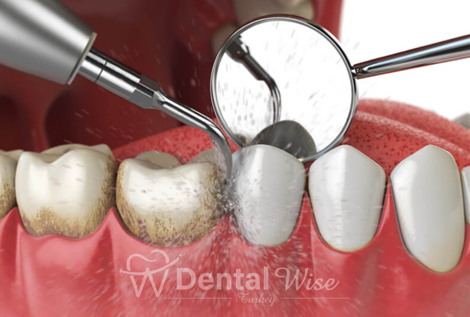 The Role Of Scaling And Root Planing