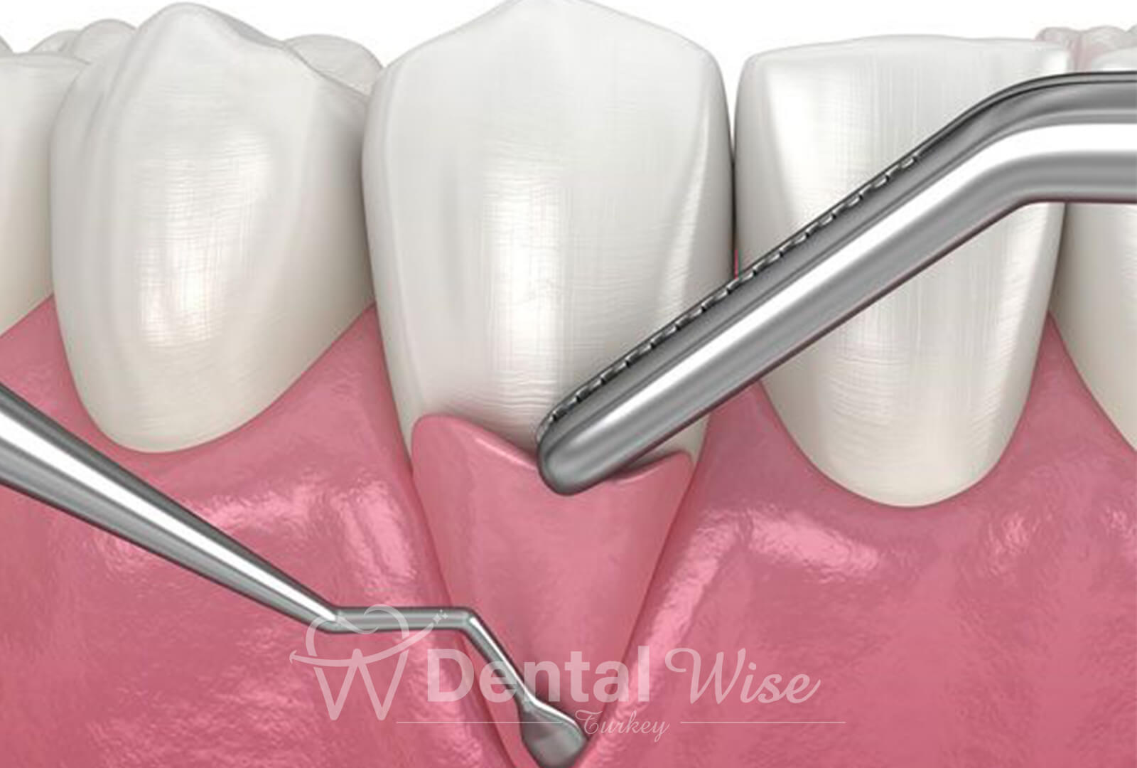 Recovery And Aftercare For Periodontal Treatments