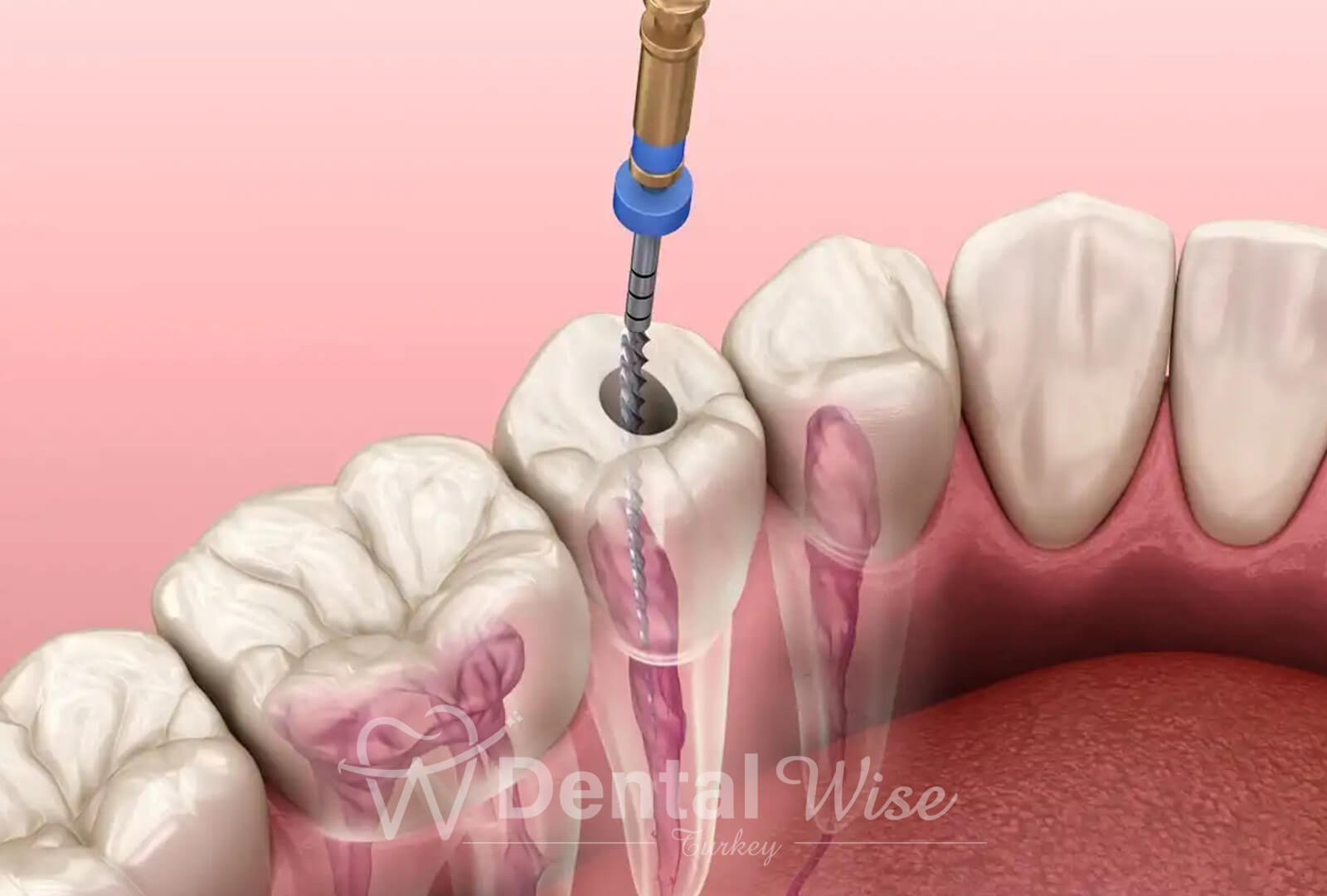 Root Canal Treatment In Antalya Turkey