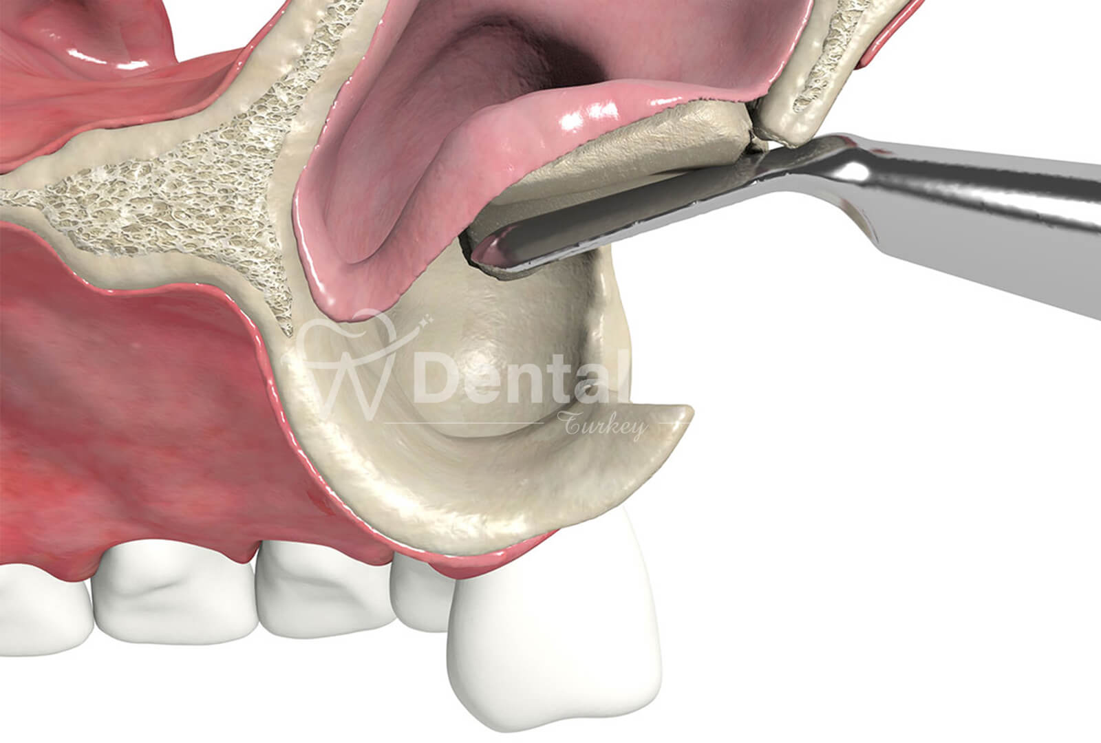 What are Sinus Lifting and Bone Grating?