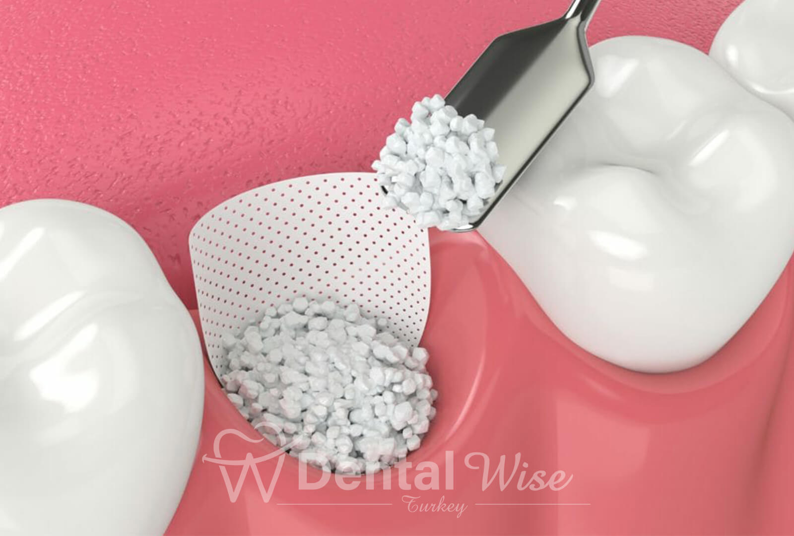 Sinus Lifting Procedure Explained