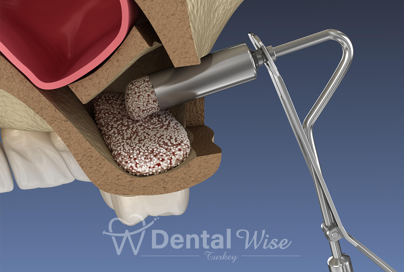 Types Of Bone Grafting Materials