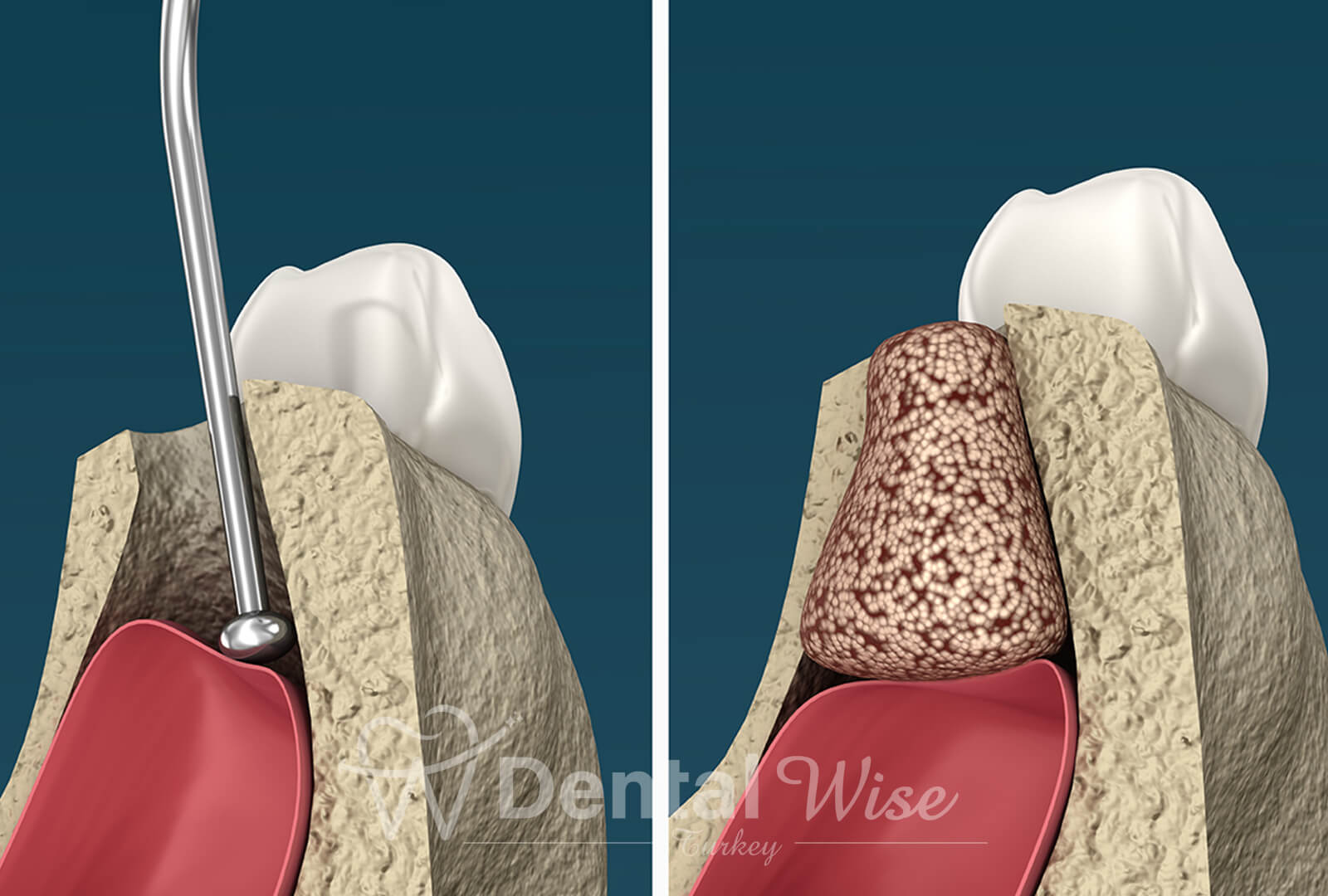 Bone Grafting Process In Sinus Lifting