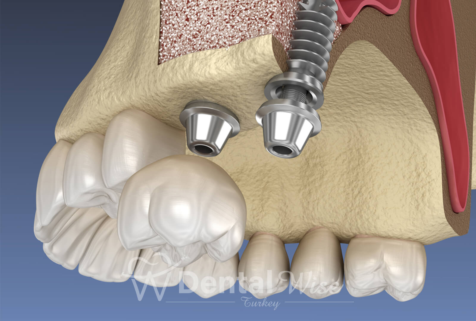 Cost And Insurance Coverage For Sinus Lifting