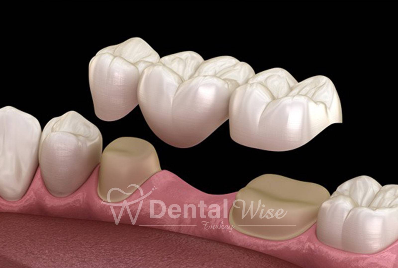 What is a Dental Bridge?