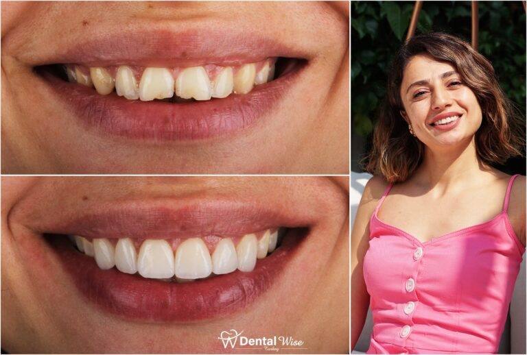 Laminate Veneer Restorations