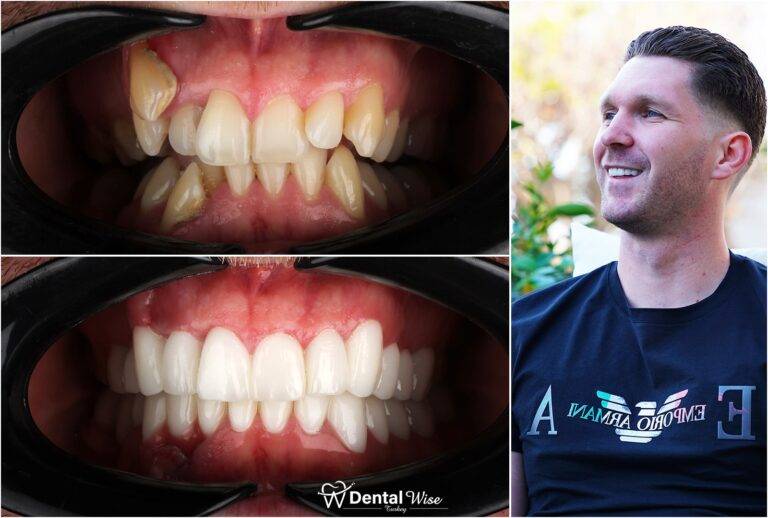 Zirconia Restorations