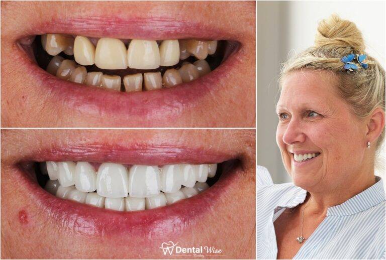 Glass Ceramic Restorations