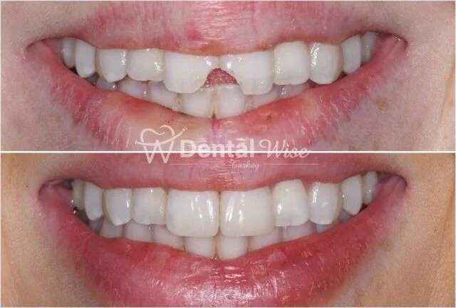 What Is Composite Bonding