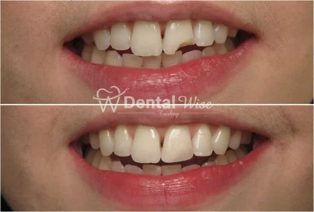 Benefits Of Composite Bonding