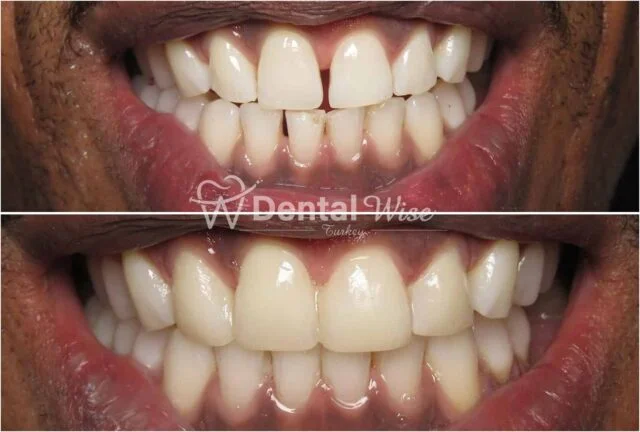 Composite Bonding Vs. Veneers