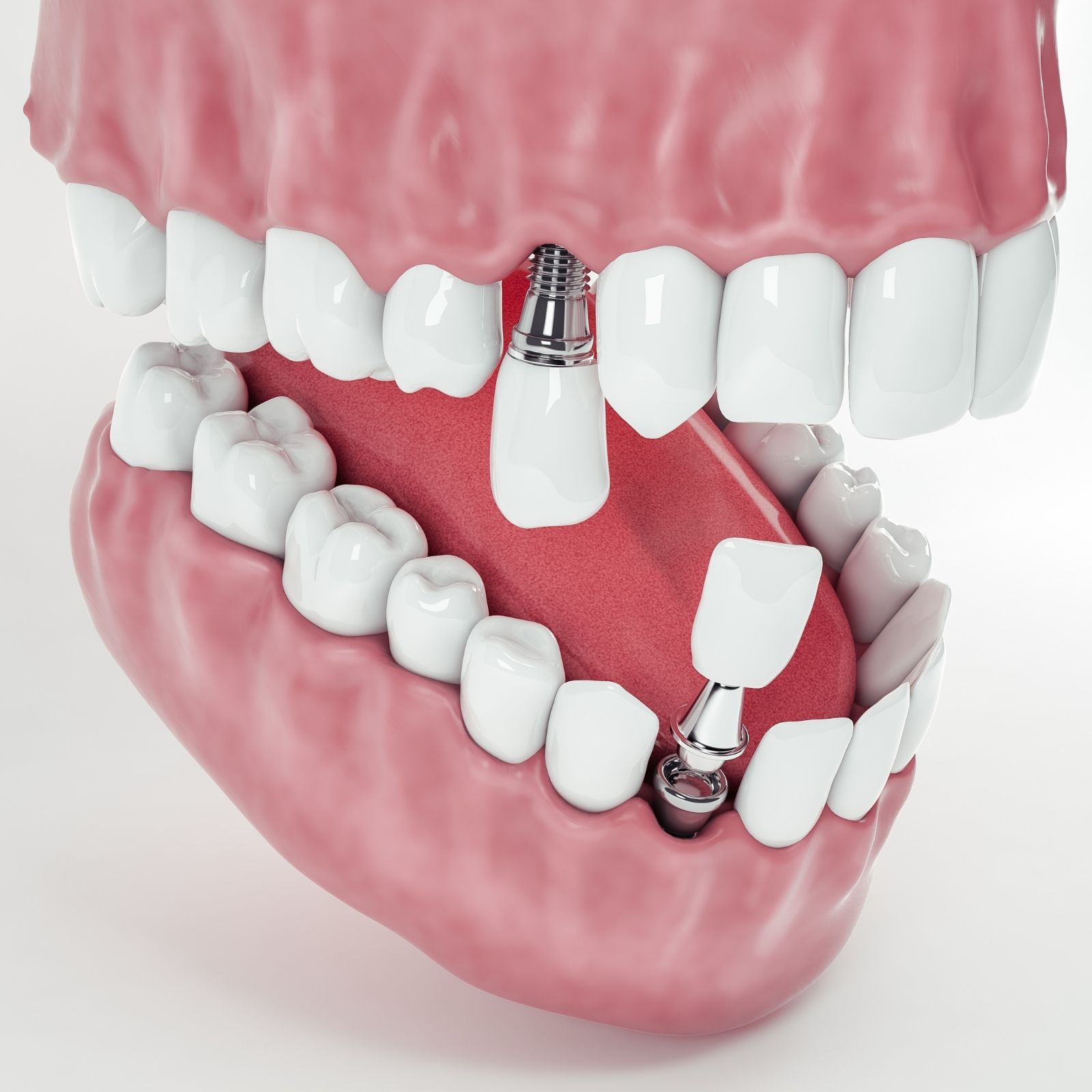 Zygomatic İmplants in Antalya 