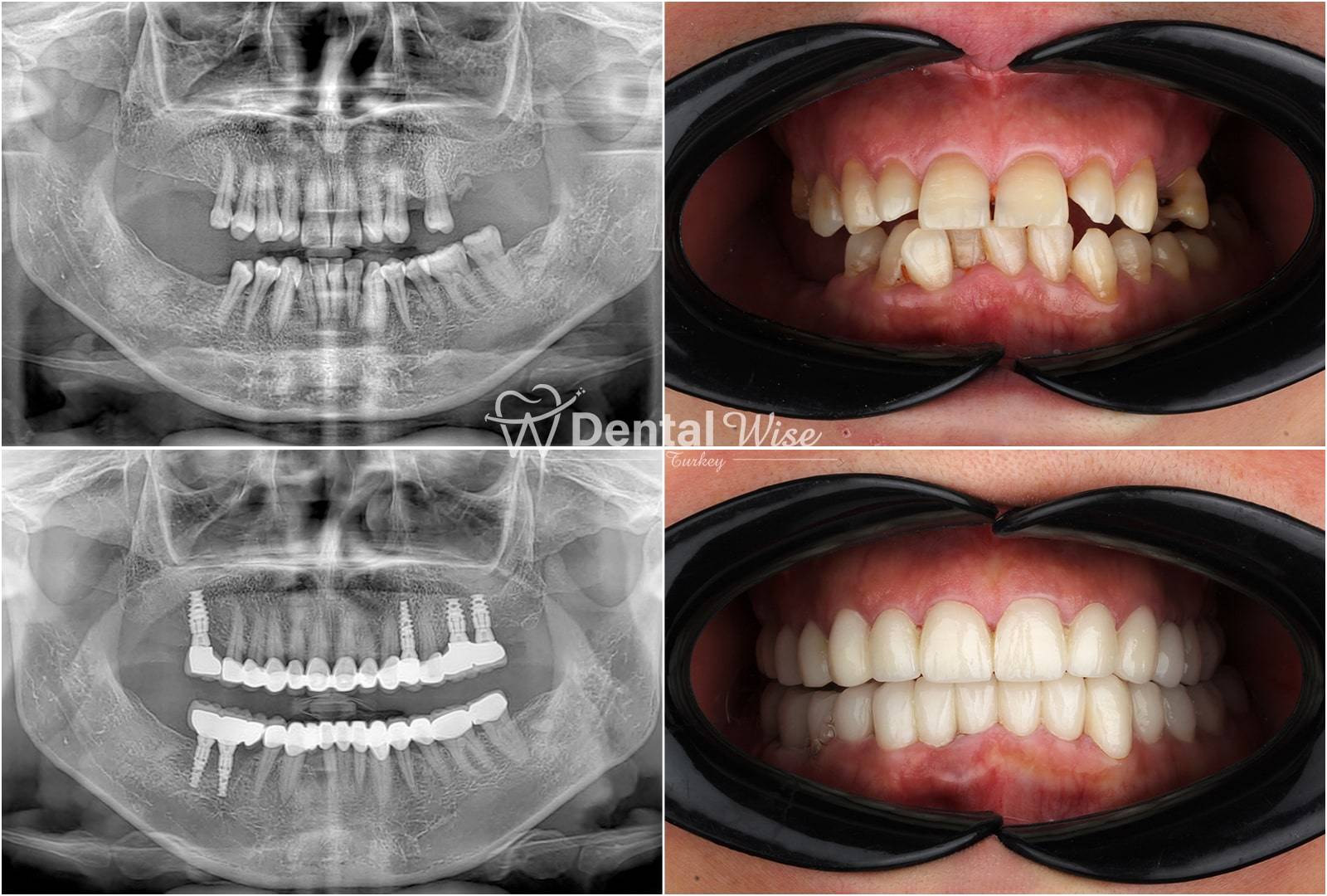 Dental Implants Turkey Prices and Reviews Wise Dental